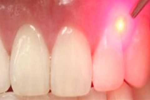How Long Do the Results of a Dental Laser Cleaning Last?
