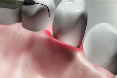 Recovery Time for Dental Laser Cleaning: What to Expect