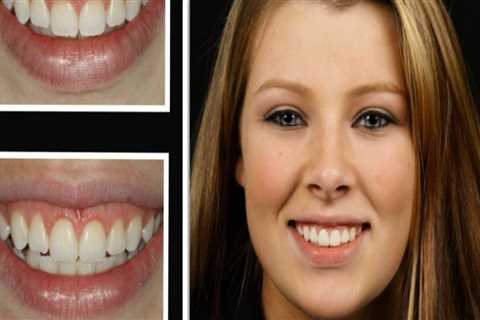 Caring for Your Teeth After a Dental Laser Cleaning