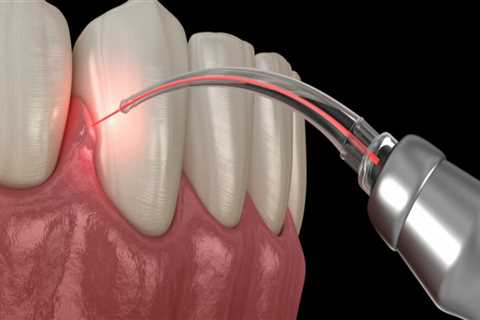 Can Laser Dentistry Treat Cavities and Fillings?