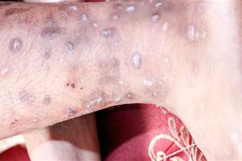 Understanding Skin Infections and How to Treat Them