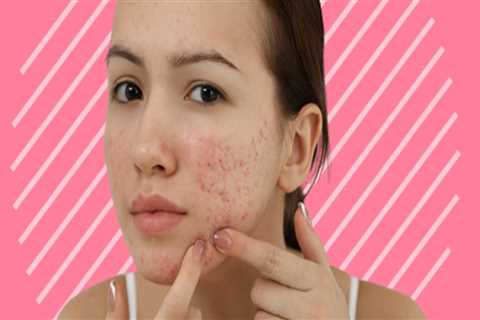 Herbal Remedies for Acne: A Comprehensive Overview
