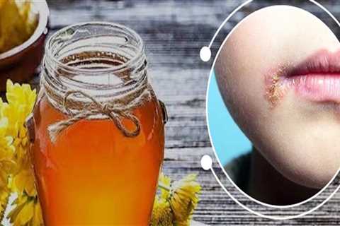 Natural Home Remedies for In-Mouth Herpes: The Benefits of Doing This Several Times a Day
