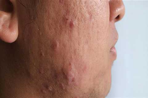 Understanding Poor Diet and Acne - A Comprehensive Overview