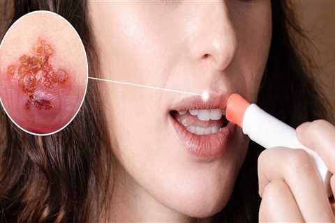 Saltwater Rinses or Gargles: A Home Remedy for Herpes Lips