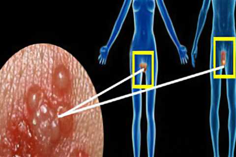 Understanding Herpes Simplex Virus (HSV)