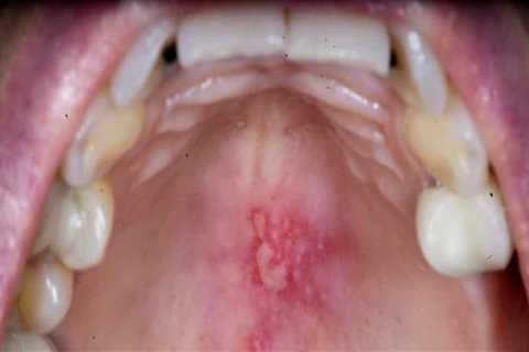 Painful Sores or Blisters in the Mouth: A Comprehensive Overview
