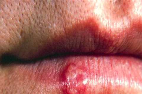 A Comprehensive Overview of Herpes Simplex Virus Type 1
