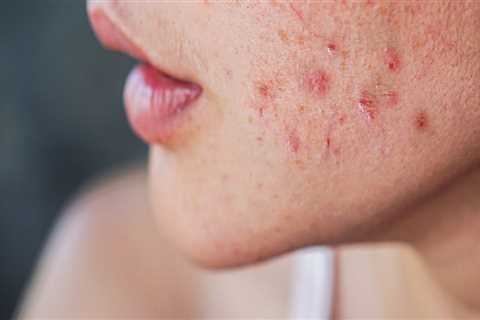 Polycystic Ovary Syndrome and Acne: What You Need to Know