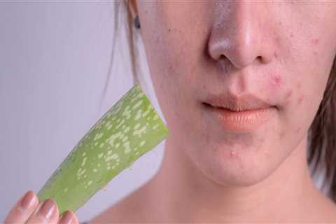Aloe Vera for Acne Scars: A Natural Remedy