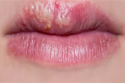 Connect with Support Groups for In-Mouth Herpes