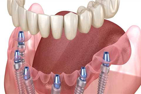 What Type of Denture Makes Patients the Happiest?