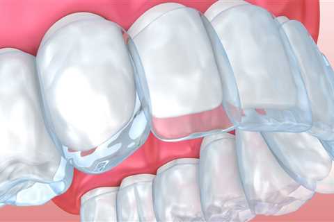 What Can I Do to Ease Pain and Discomfort from Invisalign Clear Braces?