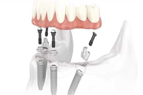 How Long Do All-on-Four Dental Implants Last?