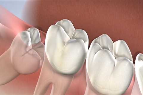 Can I Have My Wisdom Teeth Removed While Under the Effects of Sedation Dentistry?