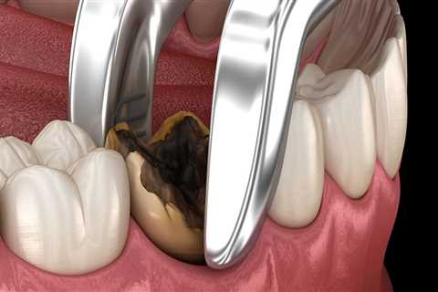 Recovery Time After a Tooth Extraction: What to Expect