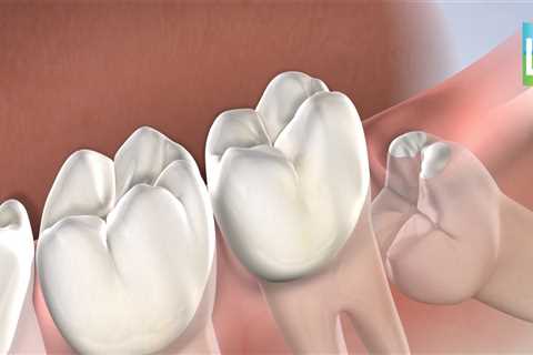 How Long Does Wisdom Teeth Removal Take with Anesthesia?