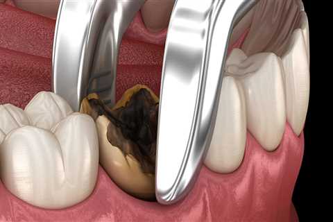 Recovery Time After Wisdom Teeth Removal: What to Expect