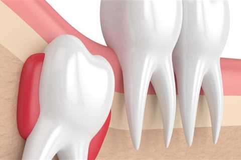 The Pros and Cons of Wisdom Tooth Extraction