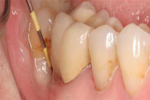 Will an Abscess Go Away After Tooth Extraction?