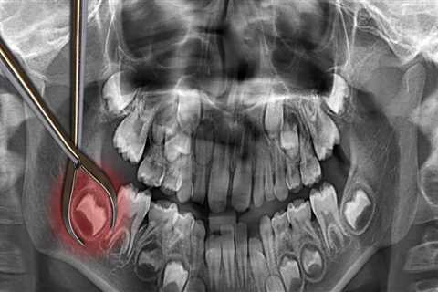 When is the Best Time to Remove Wisdom Teeth?