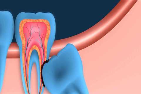 Will a general dentist remove wisdom teeth?