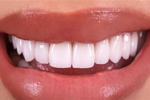 General Dentistry: What You Need To Know About Dental Veneers In London