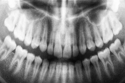 Are dental x-rays bad for you?