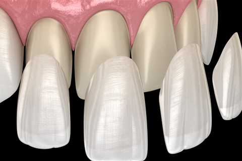 The Complete Guide To Quality Dental And Porcelain Veneers In Cedar Park