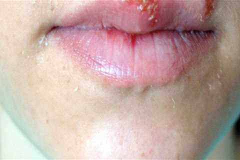 Cold Sores or Blisters Around the Mouth and Nose