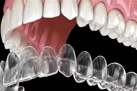 Are Clear Aligners More Expensive Than Braces?