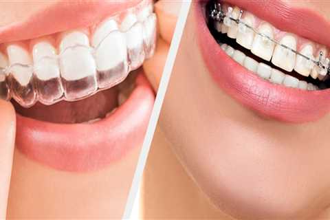 Clear Aligners vs Braces: Which is Better for Straightening Teeth?