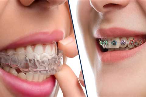 Do Clear Aligners Take Longer Than Braces?