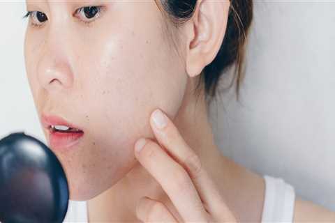 Understanding Hormonal Imbalances and Acne