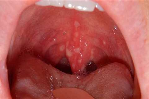 Painful Sores or Blisters in the Mouth - An Overview