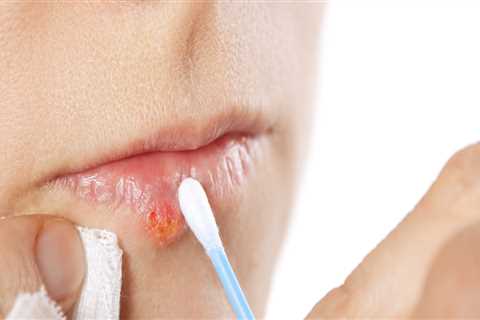 Getting Enough Rest and Exercise: A Home Remedy for Herpes Lips