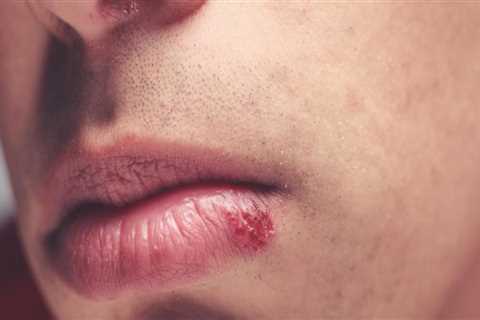 Using Tea Tree Oil for Oral Herpes