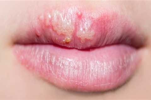 Ice Pack Treatment for In-Mouth Herpes