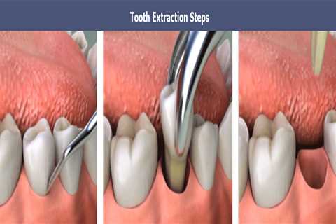Some Known Questions About Tooth Extractions.