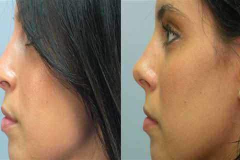 How Much Should You Budget for a Nose Job?