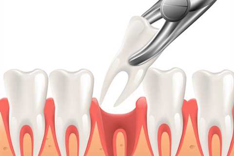 Not known Facts About Tooth Extractions
