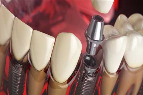 Cosmetic Dentistry In Spring Branch: A Comprehensive Guide To Dental Implants