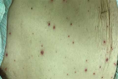 What Are the Symptoms of Varicella Zoster Virus (VZV)?