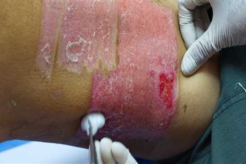 Skin Grafts: A Comprehensive Overview