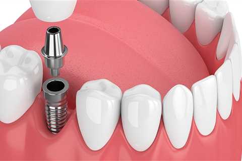 Dental Assistants Role In A Dental Implant Procedure In Texas