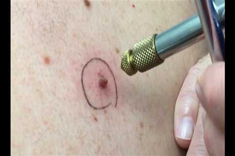 Using Liquid Nitrogen for Skin Tag Removal