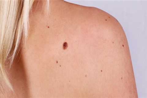 Spot Testing Home Remedies for Mole Removal: Precautions to Take