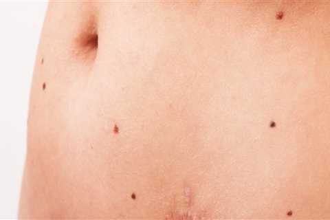 Aftercare Tips for Mole Removal Procedures: Avoiding Trauma to the Area