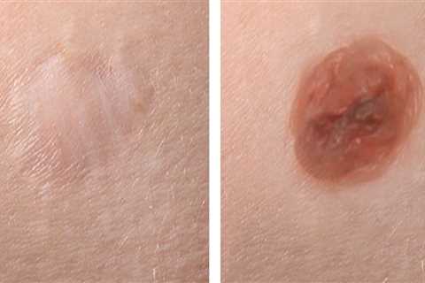 Infection and Bleeding Risks from Mole Removal Procedures