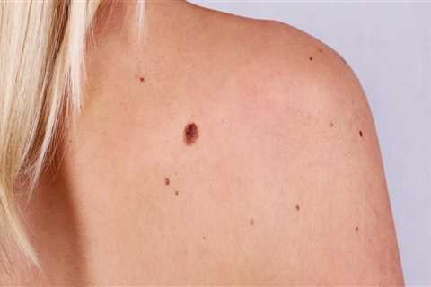 Alternative Treatments for Mole Removal